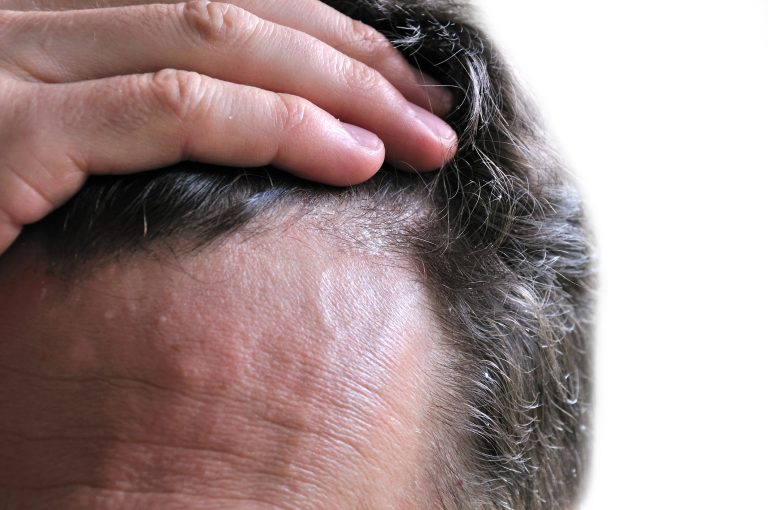 Mighty Natural Relief scalp nerve pain, psoriasis relief
